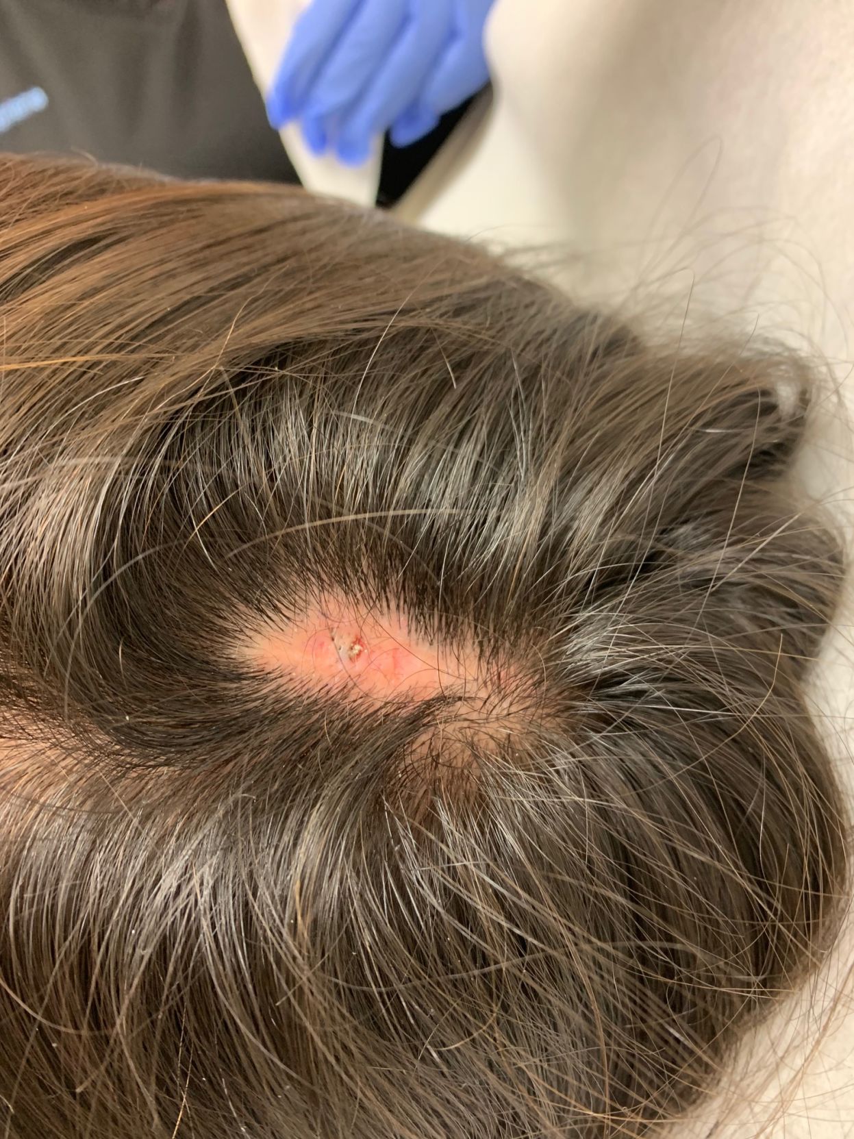 Key Cosmetic Concerns - Teen Bald Spots